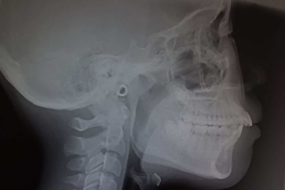 セファログラム